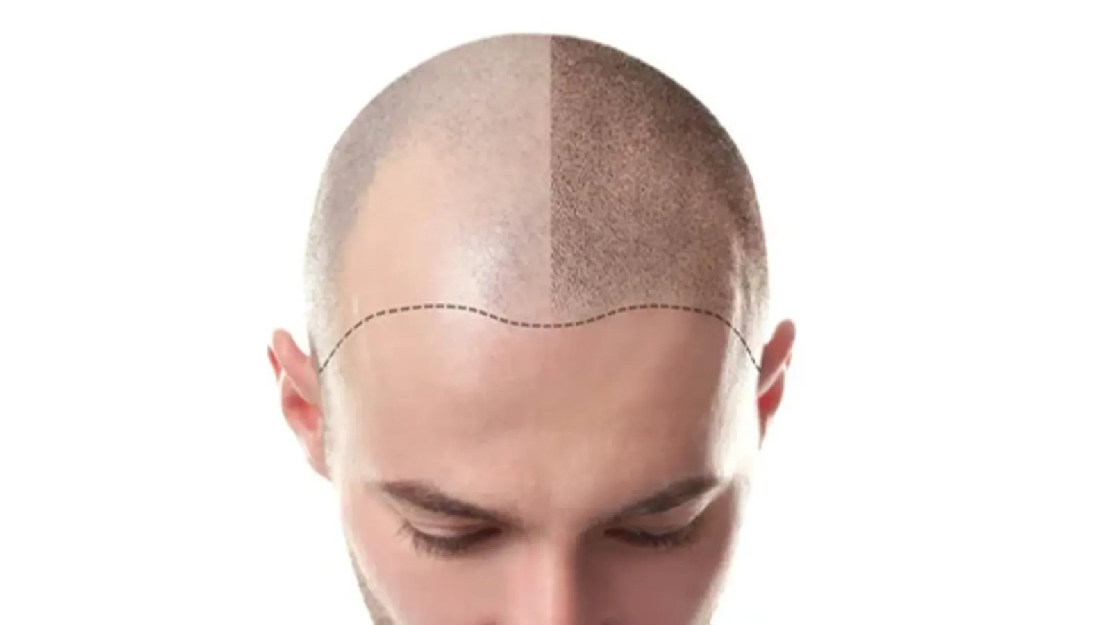 زراعة الشعر